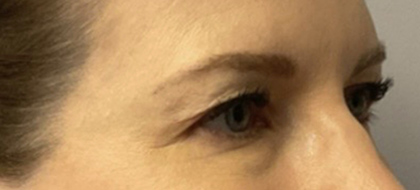 Before Image: Blepharoplasty - right-front-oblique