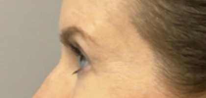 After Image: Blepharoplasty - left-side