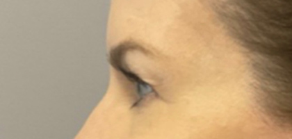 Before Image: Blepharoplasty - left-side