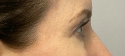 After Image: Blepharoplasty - right-side
