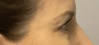 Before Image: Blepharoplasty - right-side