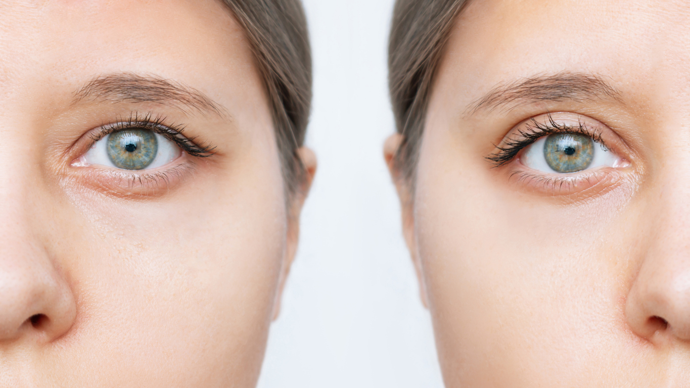 Before-and-after comparison of a woman with drooping upper eyelids showing improved eyelid position and a more open field of vision after blepharoplasty