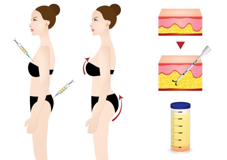 Natural Body Fat Transfer & Sculpting Procedures