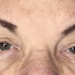 Blepharoplasty Before & After Patient #1784