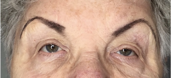 Blepharoplasty Before & After Patient #1784