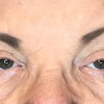 Blepharoplasty Before & After Patient #1784