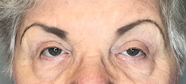 Blepharoplasty Before & After Patient #1784