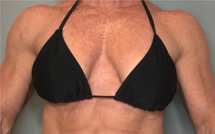 Breast Augmentation Before & After Patient #80
