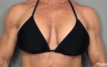 Breast Augmentation Before & After Patient #80