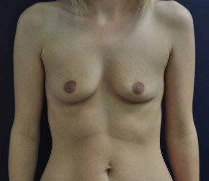 Breast Augmentation Before & After Patient #83