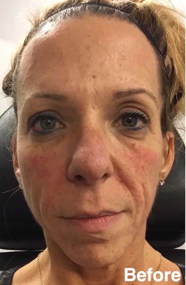 Bellafill Before & After Patient #62