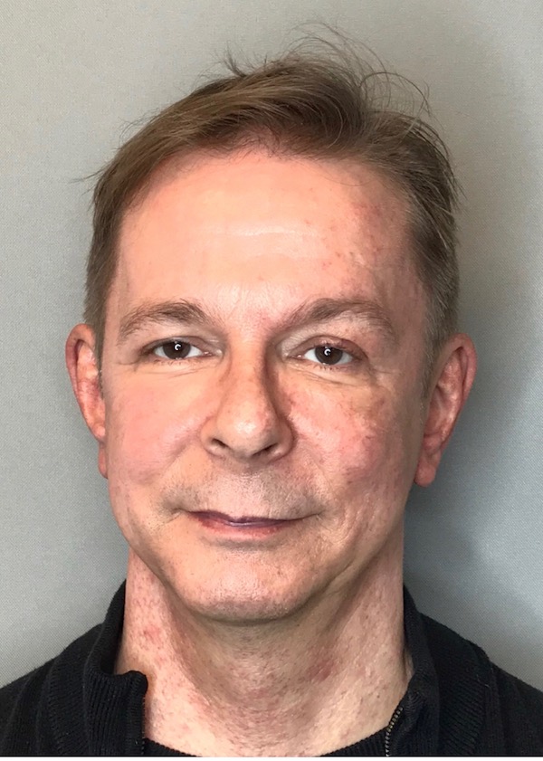 Bellafill Before & After Patient #65