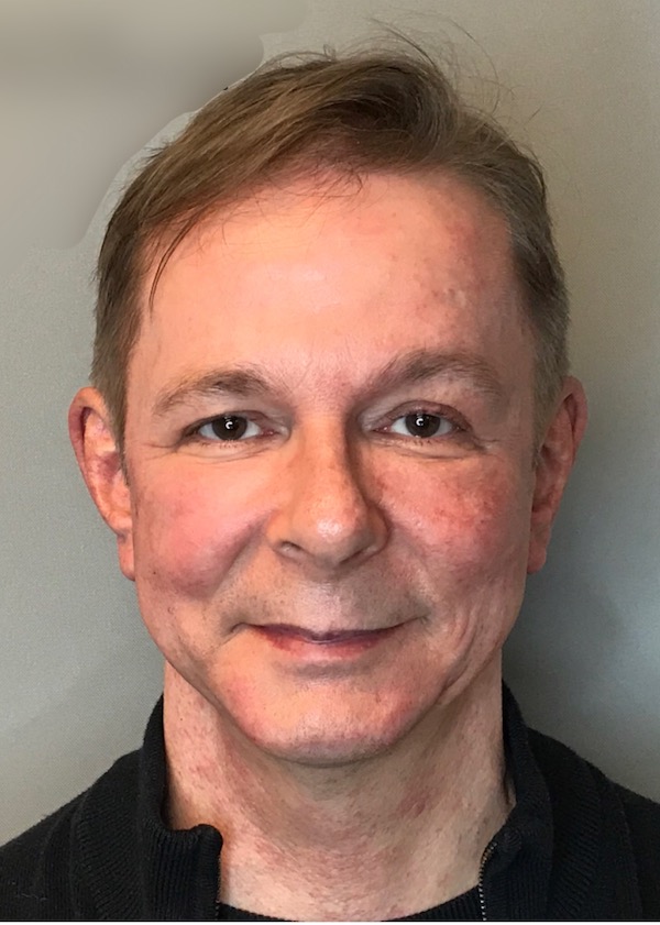 Bellafill Before & After Patient #65