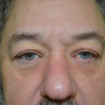 Blepharoplasty Before & After Patient #129