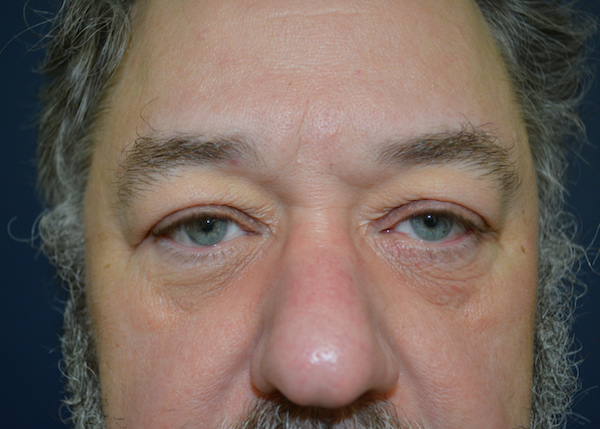 Blepharoplasty Before & After Patient #129