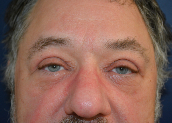 Blepharoplasty Before & After Patient #129