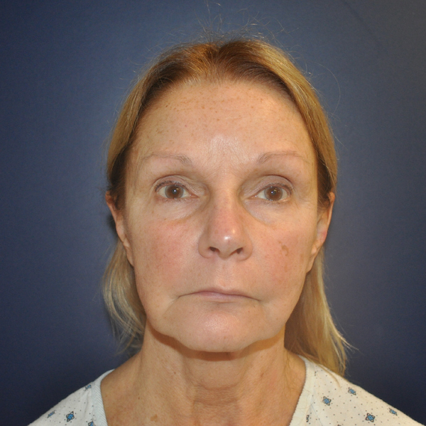 Facelift Before & After Patient #88