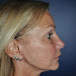 Facelift Before & After Patient #88