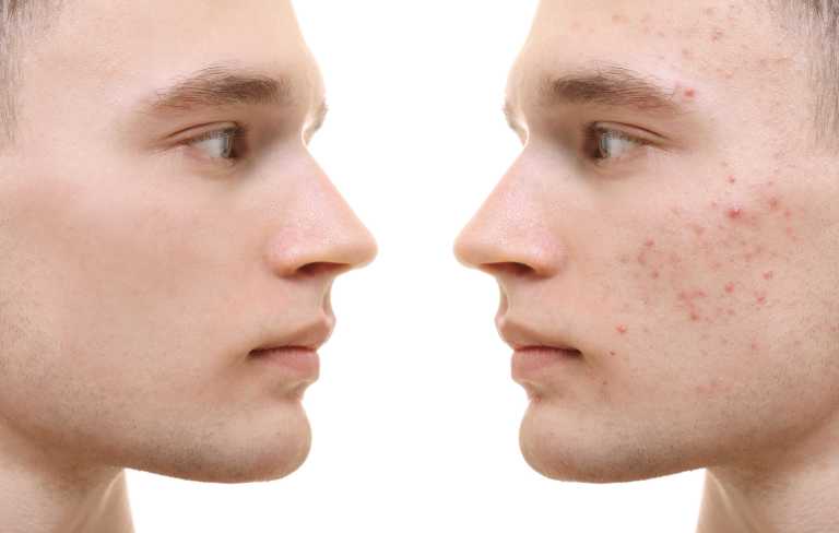 How Much Does Face Resurfacing Cost