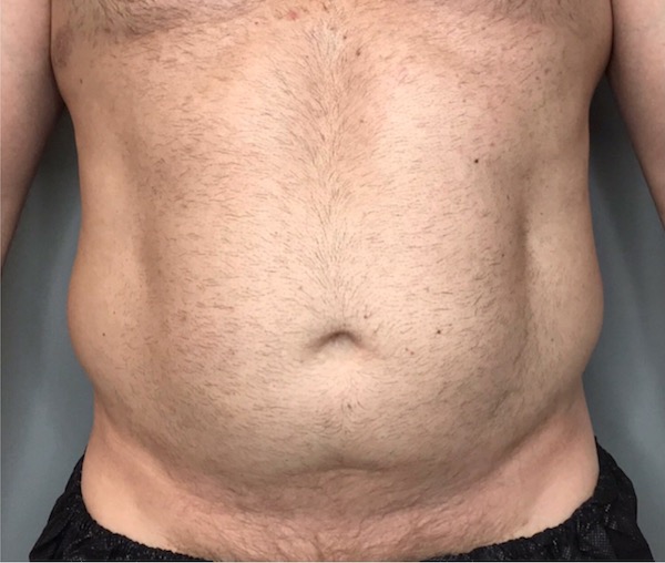 Liposuction Before & After Patient #95