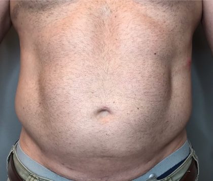 Liposuction Before & After Patient #95