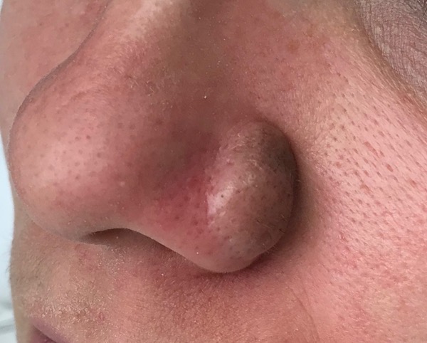 Mole Removal Before & After Patient #102