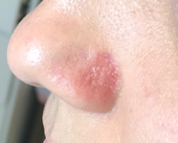 Mole Removal Before & After Patient #102