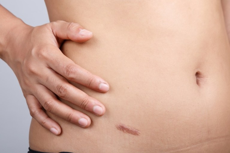 scar revision after tummy tuck