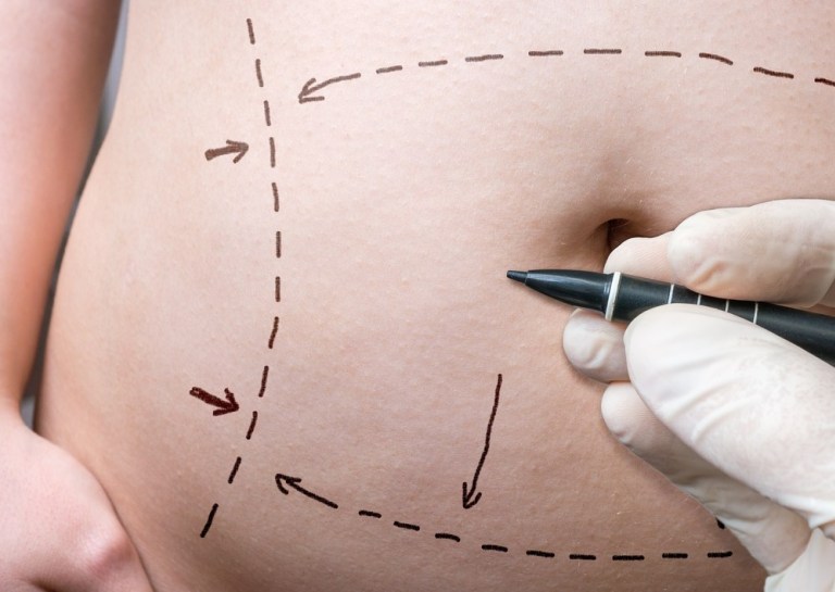 Tummy Tuck Scars - Little Rock, AR - Conway, AR - Hot Springs, AR