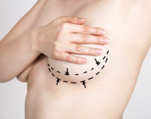 Best Breast Implant Removal & Refresh Raleigh, NC