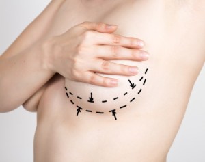 Best Breast Lift Raleigh NC Allen Aesthetic Surgery