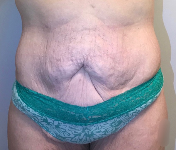 Tummy Tuck Before & After Patient #105