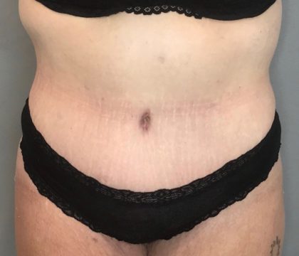 Tummy Tuck Before & After Patient #105