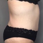 Tummy Tuck Before & After Patient #105