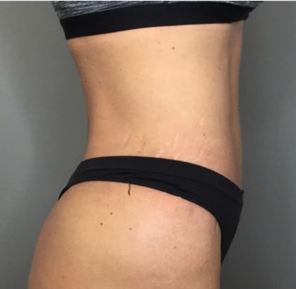 Tummy Tuck Before & After Patient #112