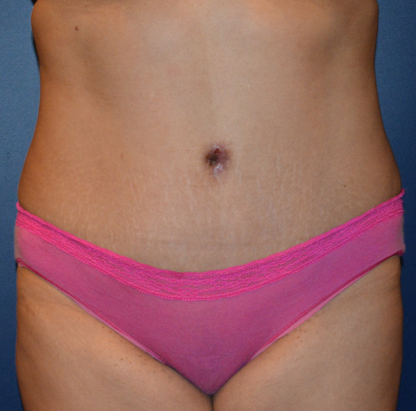 Tummy Tuck Before & After Patient #119