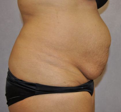 Tummy Tuck Before & After Patient #119