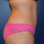 Tummy Tuck Before & After Patient #119