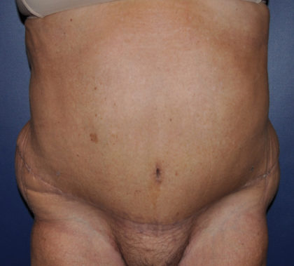Liposuction Before & After Patient #124