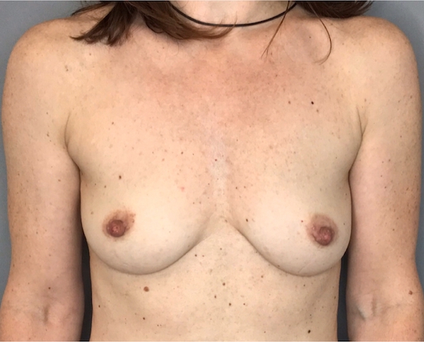Breast Augmentation Before & After Patient #1796