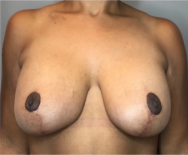 Breast Augmentation Before & After Patient #1813