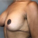 Breast Augmentation Before & After Patient #1813