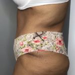 Tummy Tuck Before & After Patient #1805