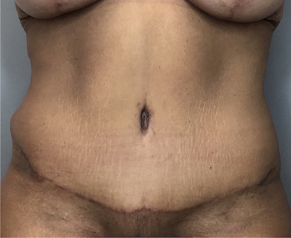 Tummy Tuck Before & After Patient #1805