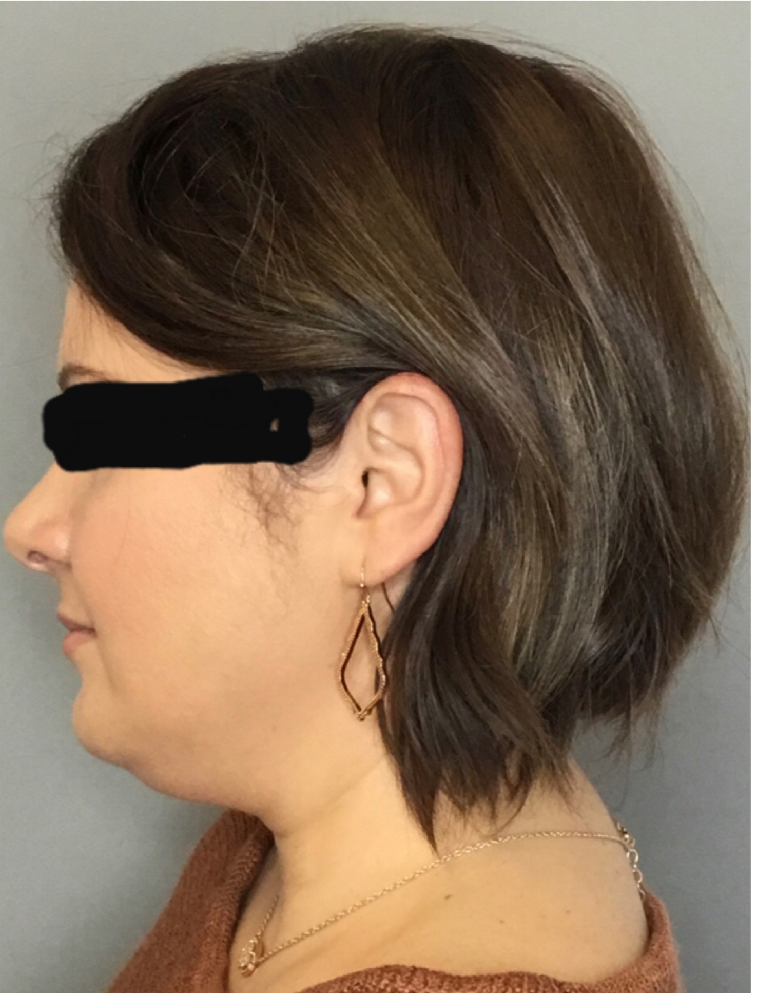 Renuvion Skin Tightening Before & After Patient #1834