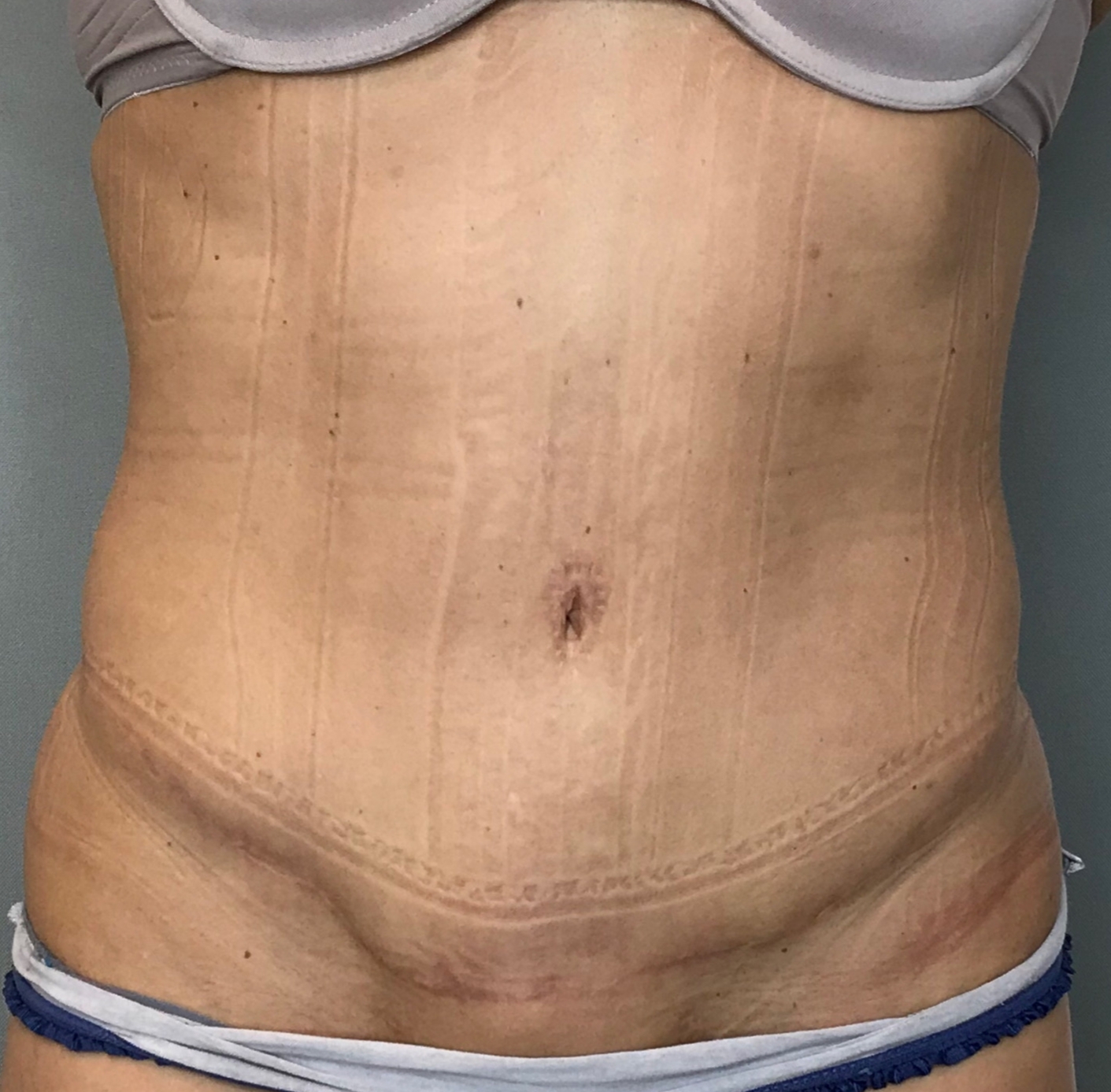 Tummy Tuck Before & After Patient #1845