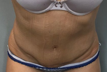 Tummy Tuck Before & After Patient #1845