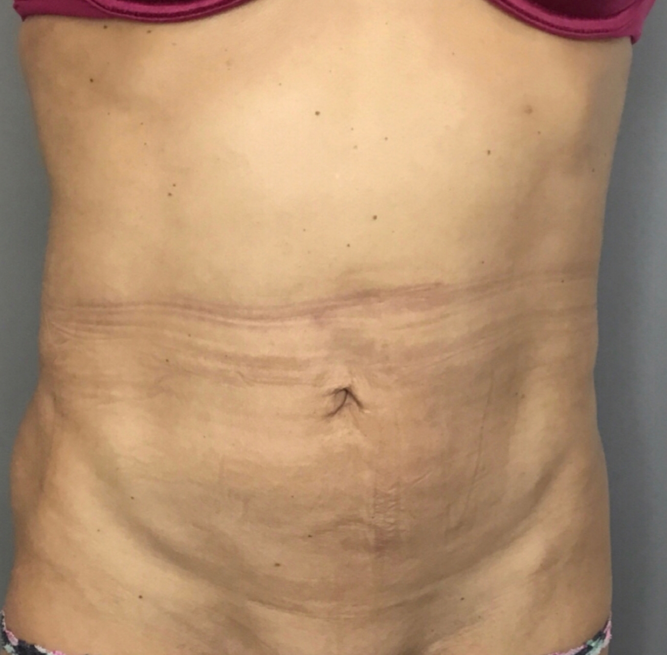 Tummy Tuck Before & After Patient #1845