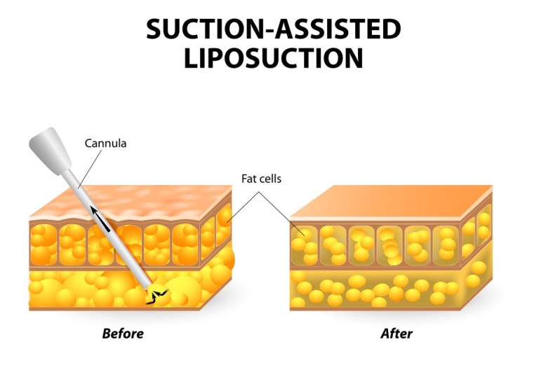 Liposuction Procedure