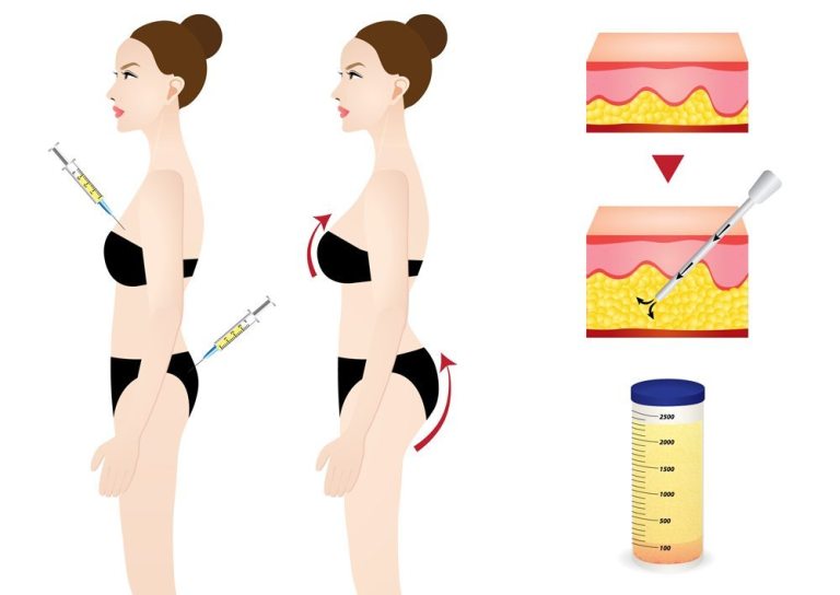 Fat Transfer After Breast Implant Removal